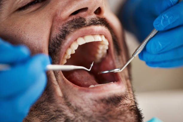 Best Emergency Dentist for Lost Fillings or Crowns in Brandermill, VA